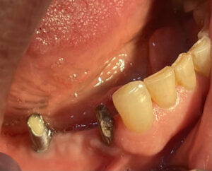  دندان های ۴ و ۵ و ۶ پایین با دو عدد ایمپلنت