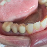 بازسازی دندان ۴ پایین با ایمپلنت