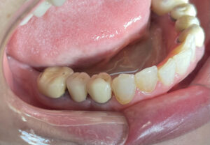 بازسازی دندان ۴ پایین با ایمپلنت