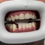 بعد از بلچینگ( همان طور که در عکس مشهود است، دندان‌ها نسبت به عکس اولیه دو درجه روشن تر شده اند)