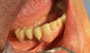 دندان های ۴ و ۵ و ۶ پایین با دو عدد ایمپلنت