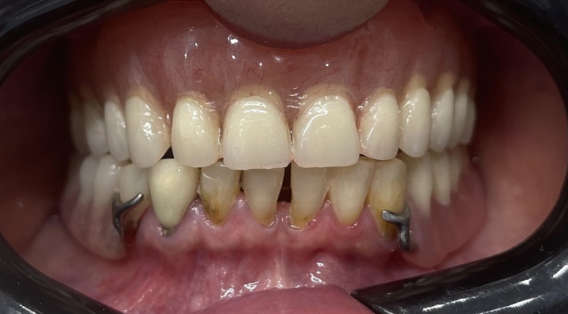 عکس داخل دهانی از بیمار پروتز متحرک ( دست دندان کامل بالا و پروتز پارسیل فک پایین)