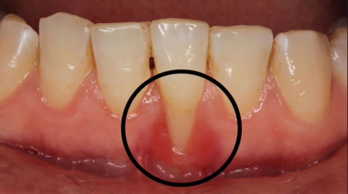 تحلیل لثه چرا اتفاق می افتد و چگونه درمان می شود؟
