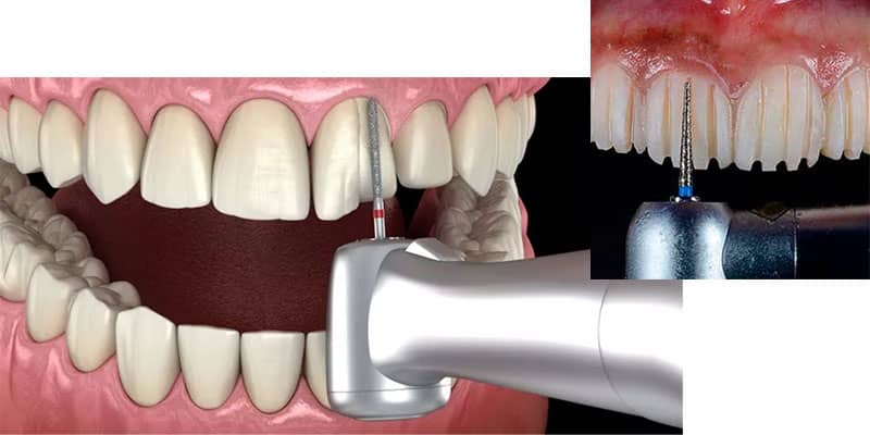 تراش دندان پیش از شروع فرآیند نصب ایمپلنت