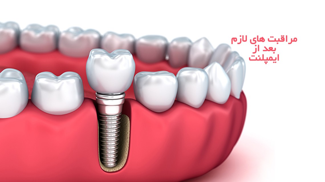 مراقبت های بعد از ایمپلنت