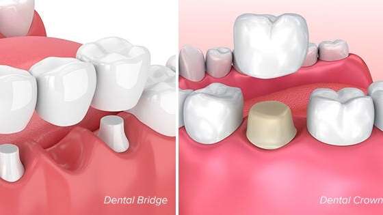 تفاوت بین پل دندان و تاج دندان