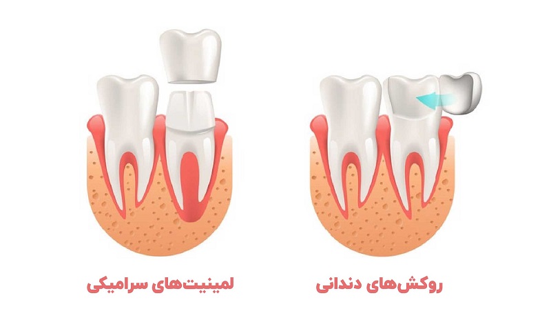 تفاوت لمینیت سرامیکی و روکش سرامیک