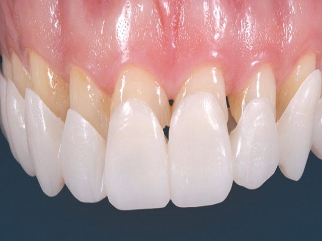 اسنپ آن اسمایل (Snap-On Smile)