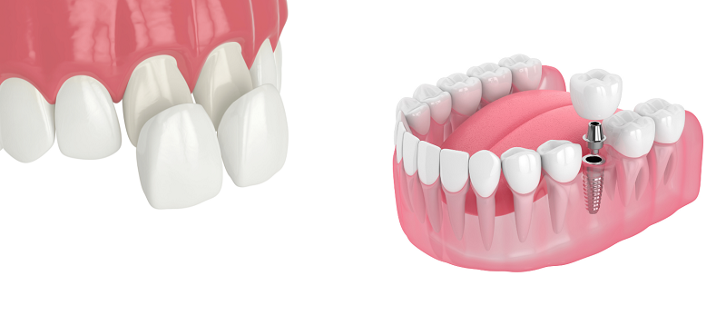 مقایسه ایمپلنت و روکش دندان