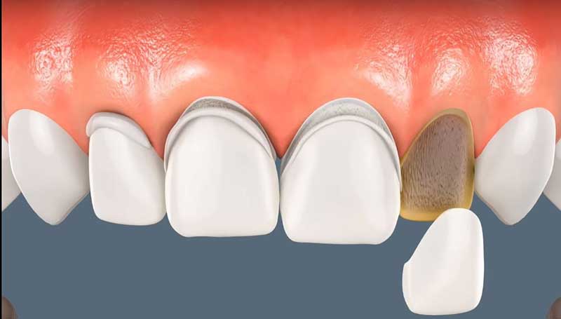 فرق روکش (crown) با ونیر دندان  (veneer)