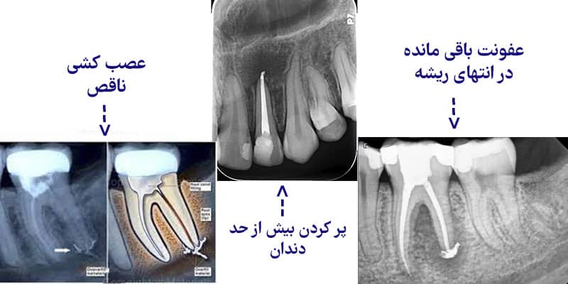 ورم و درد بعد از عصب کشی