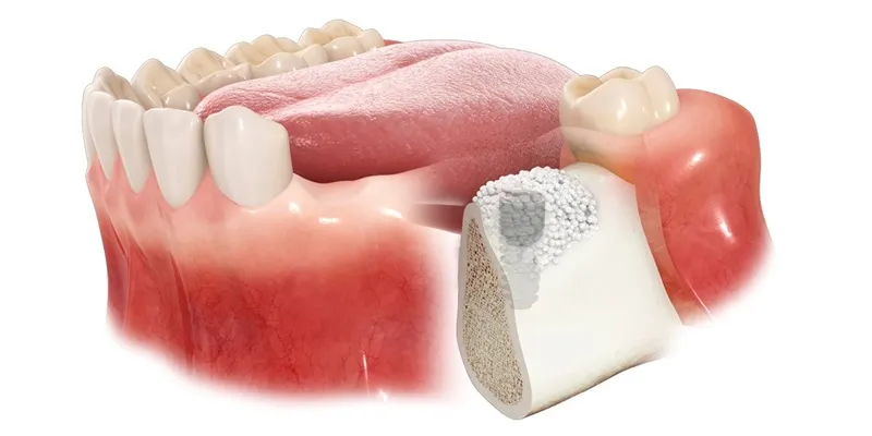 پیوند استخوان در ایمپلنت دندان